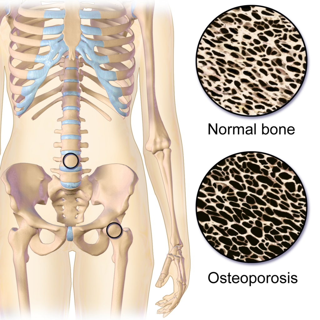 Osteoporosis Locations | Orthosports Physiotherapy by Dr. Rajani Patil